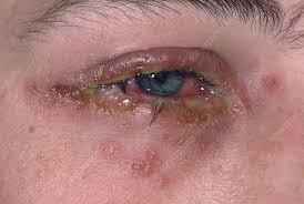herpes infection of the eye stock