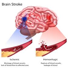What Is Stroke Cns Traumatic Brain Injury Rehabilitation