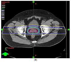 proton therapy for prostate cancer
