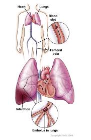 Pulmonary embolism (pe) is when a blood clot (thrombus) becomes lodged in an artery in the lung and blocks blood flow to the lung. Pulmonary Embolism Society For Vascular Surgery