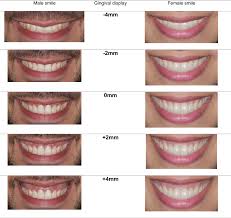 influence of gingival display on smile