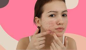 pitted acne scars