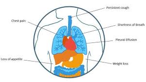 The microscopic characteristics of mpm are well defined in the new . Mesothelioma What Are It S Causes Symptoms Prognosis Learn More