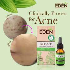 rosa t acne serum 15ml garden of eden