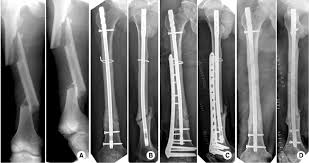 segmental fem shaft fracture