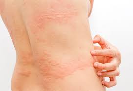 how to cure urticaria during pregnancy