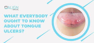 tongue ulcers