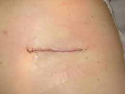 surgical removal of giant lipoma