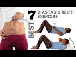 7 effective diastasis recti exercises