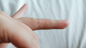 eczema blisters how to help prevent