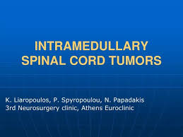 ppt intramedullary spinal cord tumors
