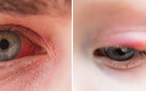 difference between a stye and pink eye