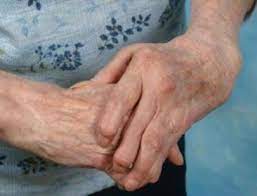 Las claves para controlar la artritis reumatoidea - Ciencia y Salud |  Diario La Prensa