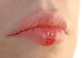 palms and arms and blister on lower lip