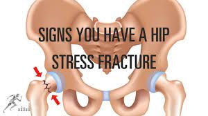 fem neck stress fracture signs