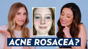 can you have acne and rosacea