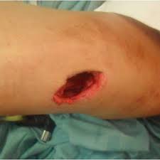 Jun 13, 2021 · u.s. Bullet Wound Of The Left Foot A Associated With A Fracture Of The Download Scientific Diagram