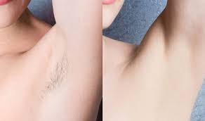The cost of professional laser hair removal is mainly determined by your geographic location, the size of the treated area, specific patient needs, and the the 2019 laser hair removal cost statistics report, which includes the average fees of ipl services performed by laser technicians in medical. Best Laser Hair Removal In Dubai Abu Dhabi Hair Reduction Uae Cost