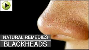 Article table of contents what causes whiteheads on your nose? Skin Care Blackheads Natural Ayurvedic Home Remedies Youtube