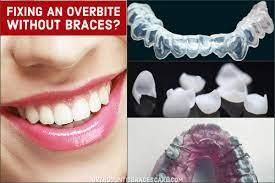 It's often called 'overbite' although this is not the correct term and an orthodontist would always use the term, overjet. How To Fix An Overbite Without Braces Orthodontic Braces Care