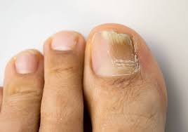 home remes for nail fungus