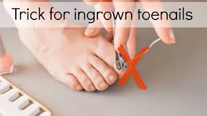 how to fix ingrown toenails easily