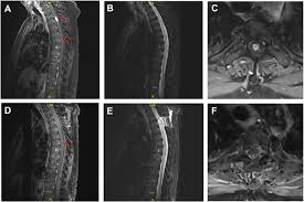 intramedullary spinal cord tumor