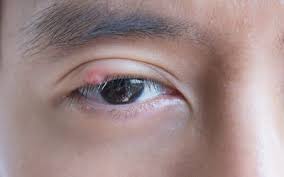 swollen eyelid 9 common causes