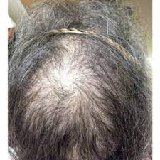 hair thinning over the crown of scalp