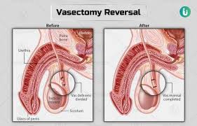 A vasectomy is a reliable form of birth control that helps prevent unplanned pregnancy. Vasectomy Reversal Procedure Purpose Results Cost Price