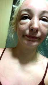 woman s face badly swollen after she