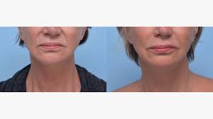 botox for smile lines procedure cost