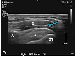 A cervical epidural steroid injection may be performed to reliev. Aspetar Sports Medicine Journal Ultrasound Guided Injections