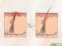 how to remove an ingrown hair 10