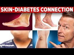 9 diabetic skin problems that indicate