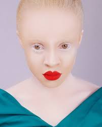 can people with albinism dye their hair