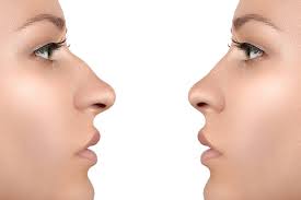rhinoplasty can fix a crooked nose