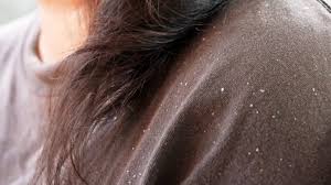 8 ways to remove dandruff without