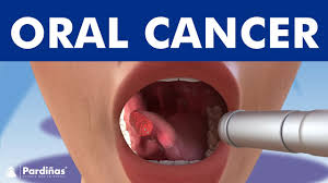 cancer and tumors in the mouth