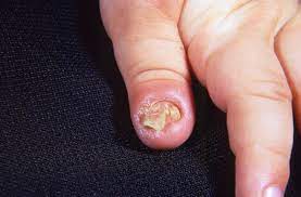 ayurveda treatment for nail fungus