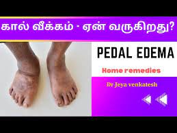 leg swelling causes treatment