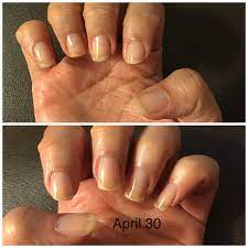 how to save and regrow nails after a break
