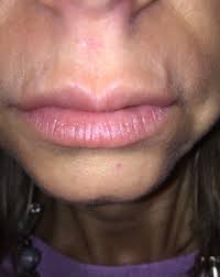 visible veins above lip after vobella
