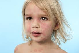 Roseola rash, find out how long does it last. 10 Common Childhood Rashes Baby Gooroo