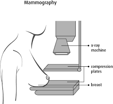 Mammography Canadian Cancer Society