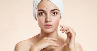 all about acne mizu aesthetic clinic