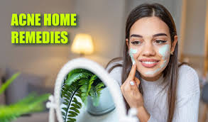 home remes for pimples and acne