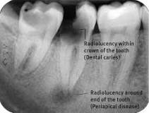 Image result for icd 10 cm code for dental abscess