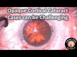 Opaque Cortical Cataract Cases Can Prove Challenging During Surgery