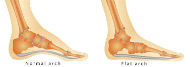 * transverse arch of the foot * longitudinal arch of the foot. Fallen Arches Symptoms Causes Exercises Treatment Diagnosis